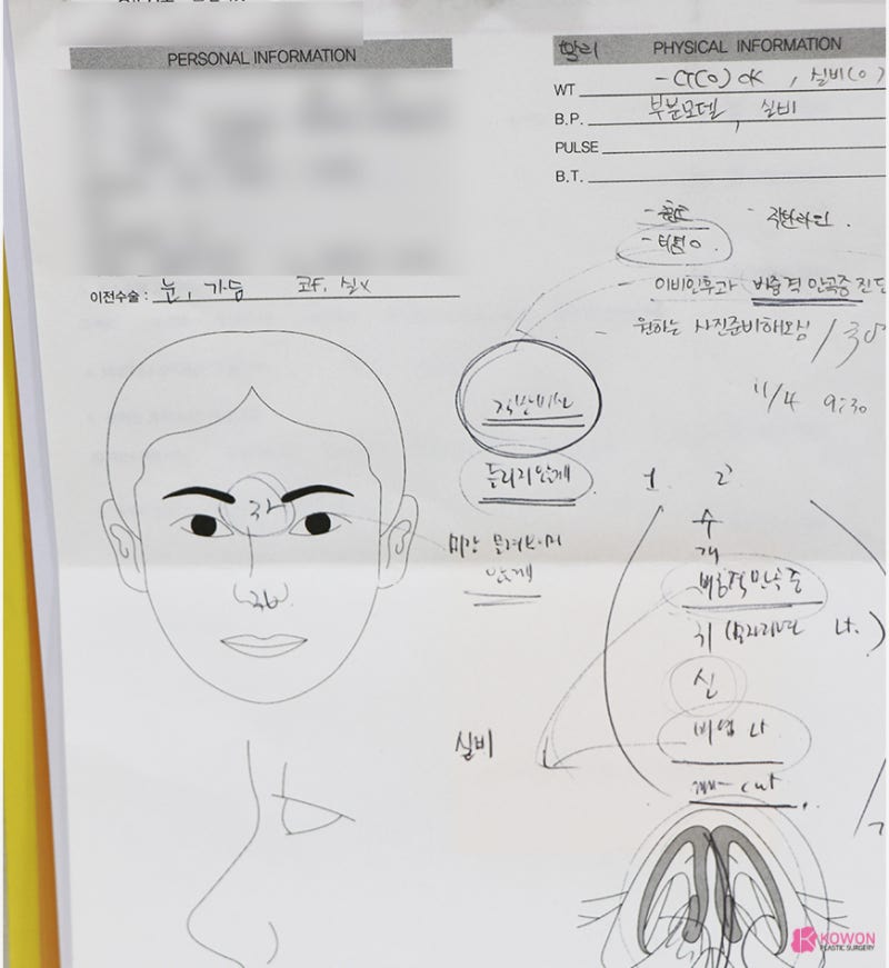 강남코성형 직반버선 모양의 비중격만곡증수술후기 사진 3