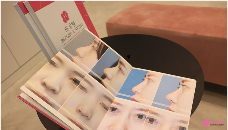 강남코성형 직반버선 모양의 비중격만곡증수술후기