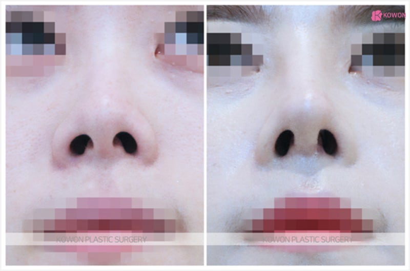 강남코재수술 비대칭 짝콧구멍 코 성형으로 해결 사진 5