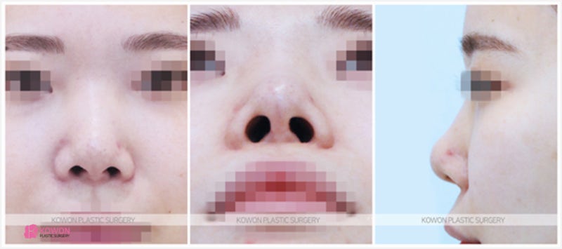성형전문의 자가늑을 이용한 코재수술성형외과 사진 4