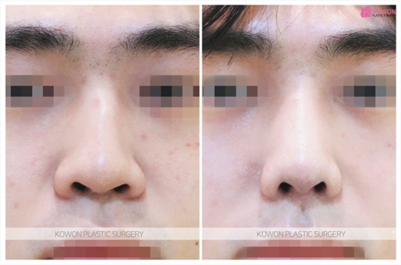 남자코성형잘하는곳 휘어진 매부리코성형후기 사진 5