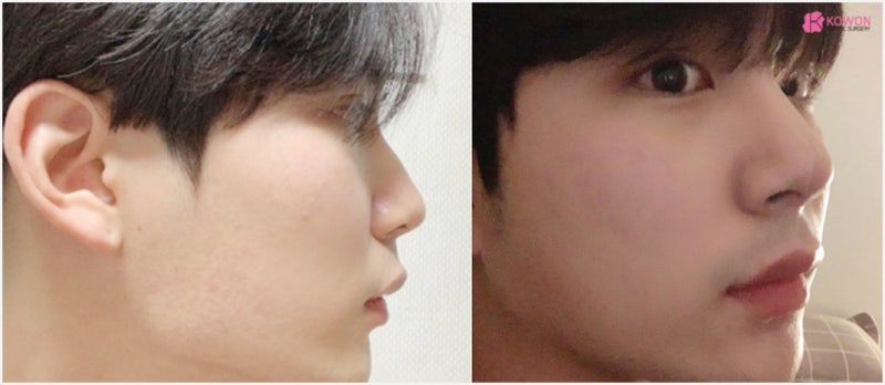남자코수술 남성적인 이미지의 직선코성형