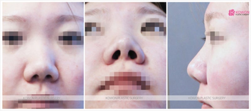반포동성형외과 코 끝 길이 연장 여자돼지코 수술 사진 2
