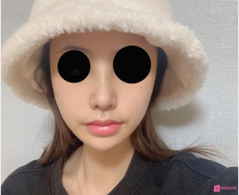 서초동성형외과 펑퍼짐한코 확실한 수술 전후 차이 사진 10