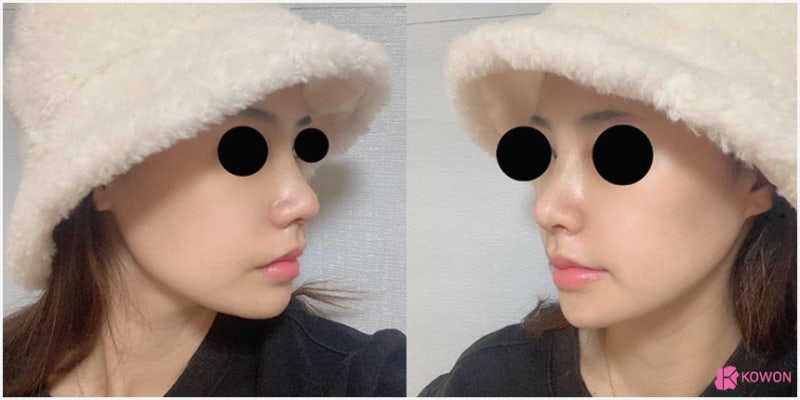 서초동성형외과 펑퍼짐한코 확실한 수술 전후 차이 사진 8