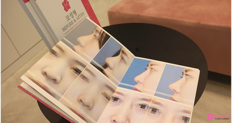 서초동성형외과 펑퍼짐한코 확실한 수술 전후 차이
