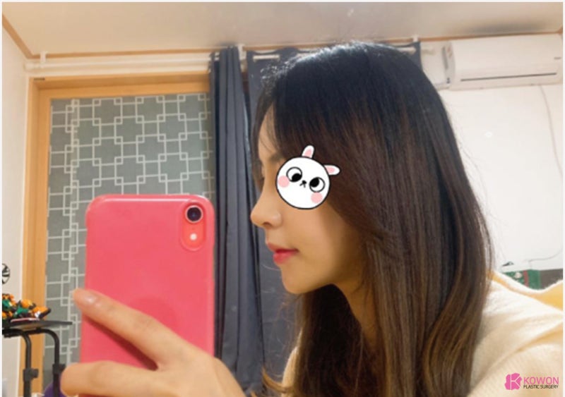 서초동성형외과 펑퍼짐한코 확실한 수술 전후 차이 사진 5