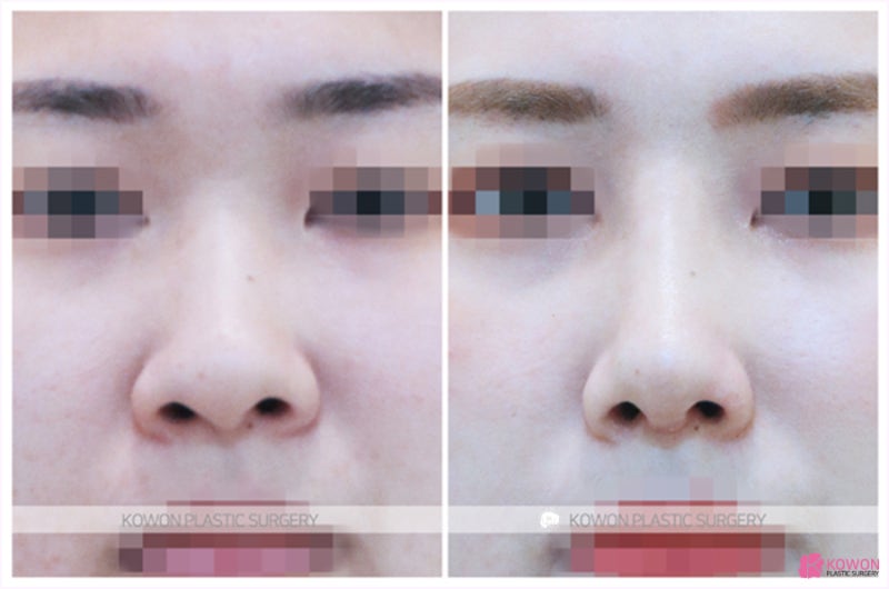비절개코성형 뭉툭함 해결한 복코수술전후 사진 사진 5