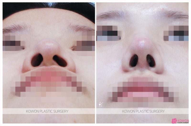 서울코수술잘하는곳 매부리절골 휘어진 코 개선 사진 7