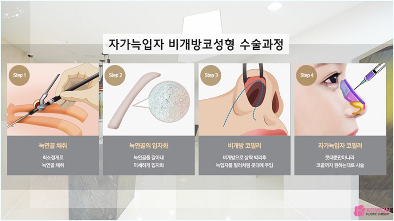 비개방코성형 염증 가능성 낮은 자가늑입자 사진 4