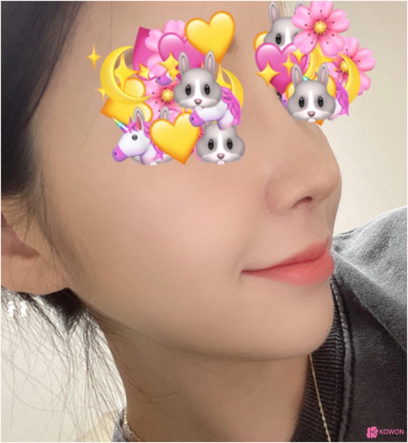코 비중격 코필러후성형 복코에서 갸름한 콧날로 사진 9