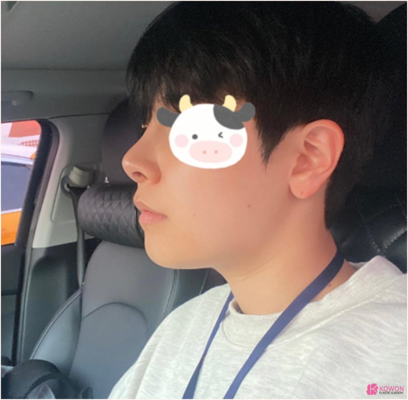 코연골재수술 바비톡후기 보고 결정한 사례 사진 4