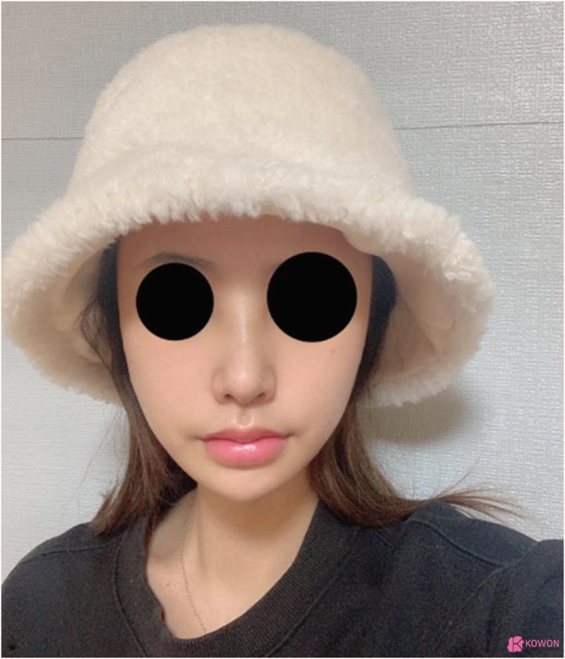비중격만곡증성형 콧대 높인 직반버선코후기 사진 10