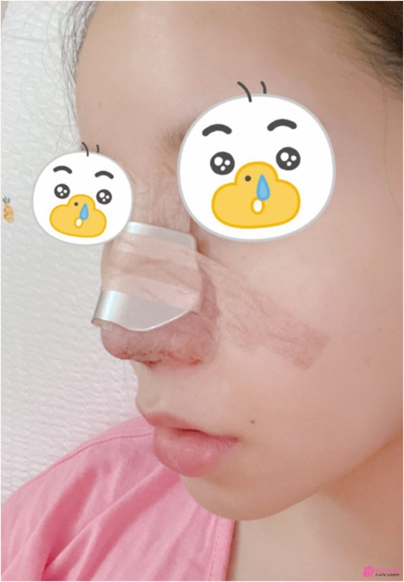 여자복코수술 비중격 교정까지 코재수술잘하는곳 사진 5