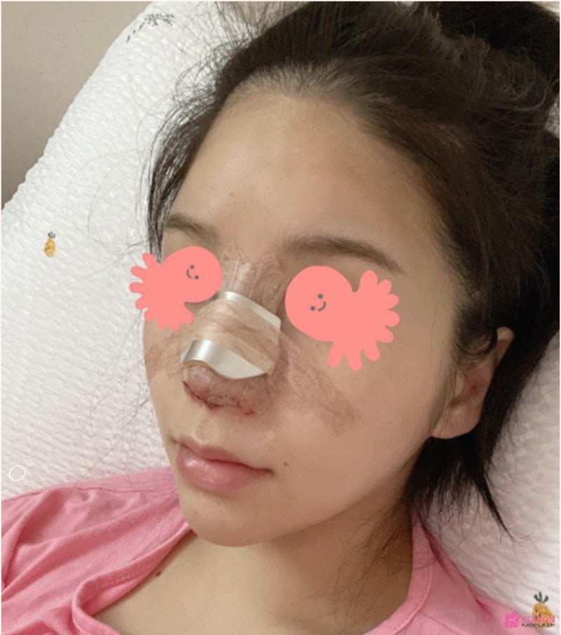 여자복코수술 비중격 교정까지 코재수술잘하는곳 사진 6