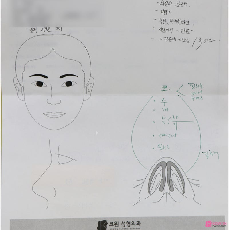 콧대낮음 개선한 코필러흡수 수술 사례