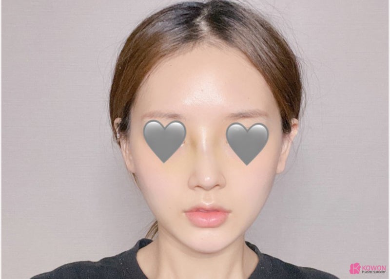 콧대낮음 개선한 코필러흡수 수술 사례 사진 6