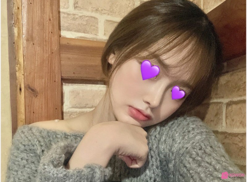 콧대낮음 개선한 코필러흡수 수술 사례 사진 9