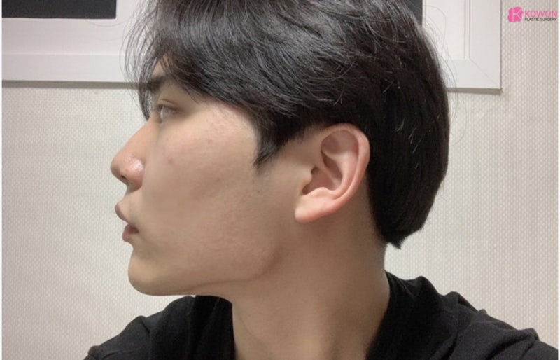 남자매부리코 수술로 옆모습못생김 콤플렉스 해결 사진 3