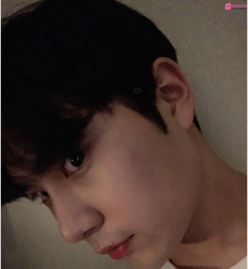 남자매부리코 수술로 옆모습못생김 콤플렉스 해결 사진 8