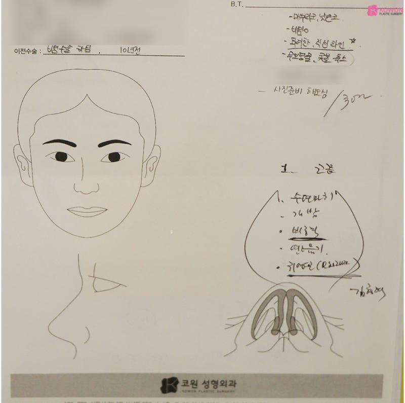 남자매부리코 수술로 옆모습못생김 콤플렉스 해결 사진 2