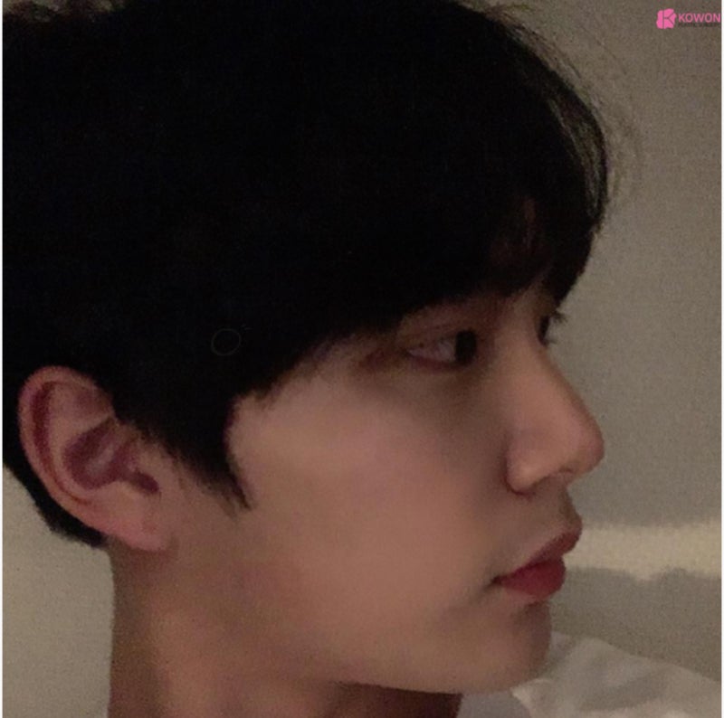 남자매부리코 수술로 옆모습못생김 콤플렉스 해결 사진 9