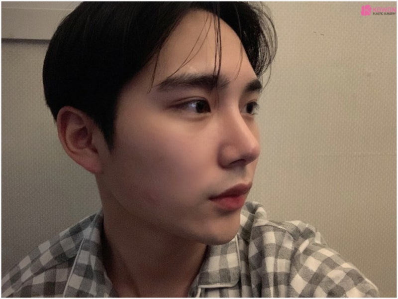 남자매부리코 수술로 옆모습못생김 콤플렉스 해결 사진 5
