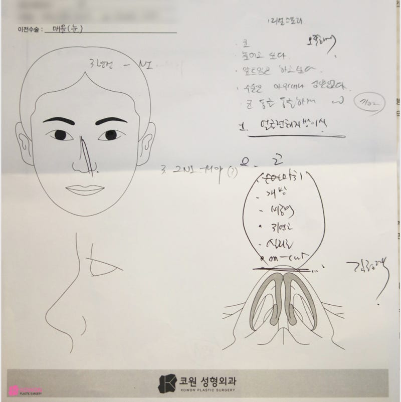 신사성형외과 작은코수술 사례와 방법 소개 사진 2