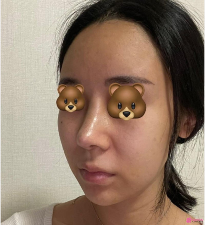 코끝처짐 재수술 세파알러지 사전 대비로 사진 6