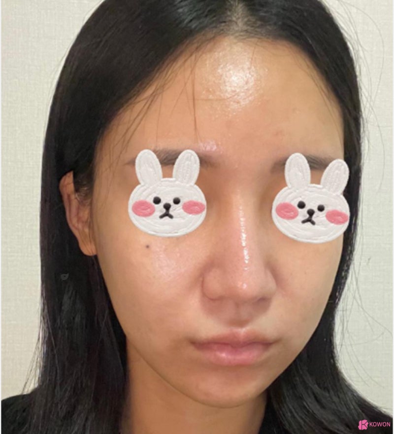 코끝처짐 재수술 세파알러지 사전 대비로 사진 4