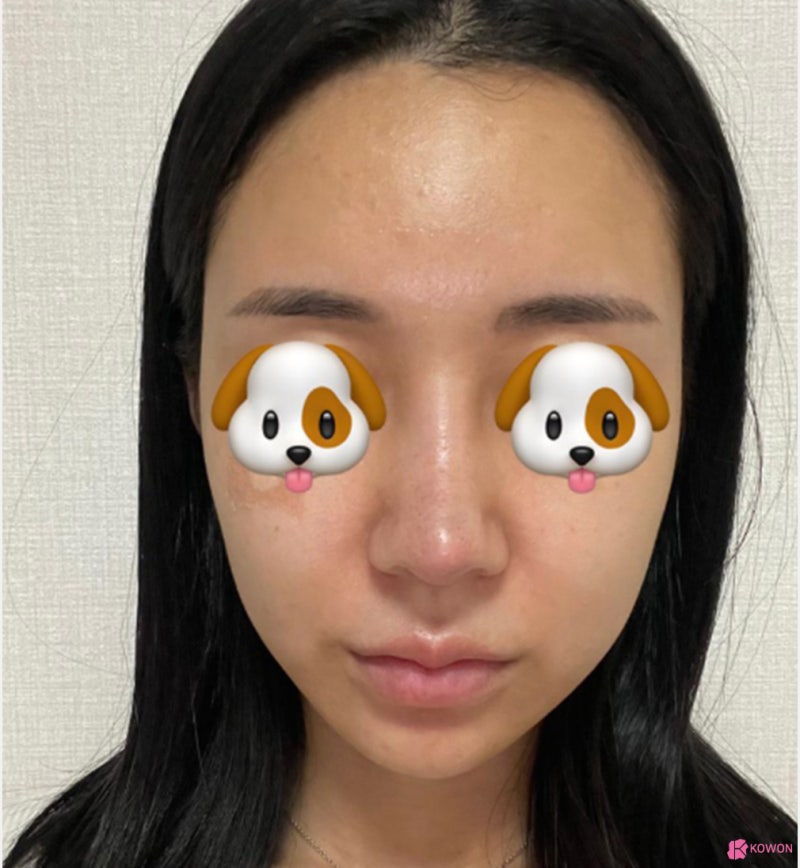 코끝처짐 재수술 세파알러지 사전 대비로 사진 8