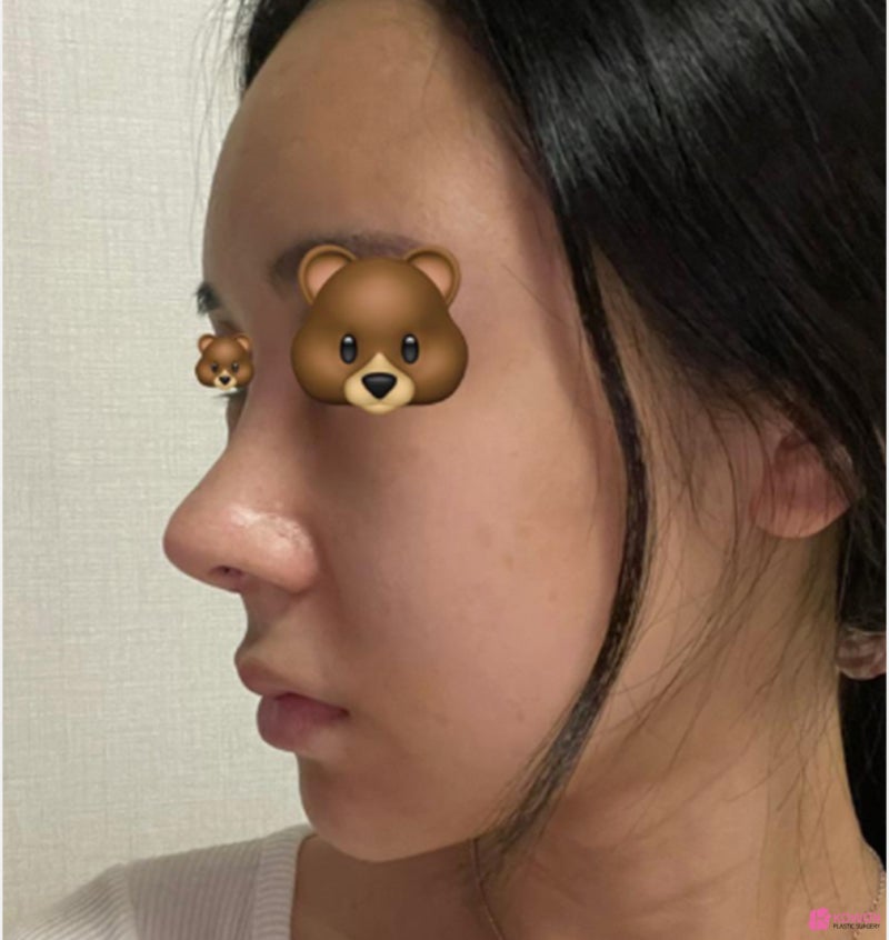 코끝처짐 재수술 세파알러지 사전 대비로 사진 7
