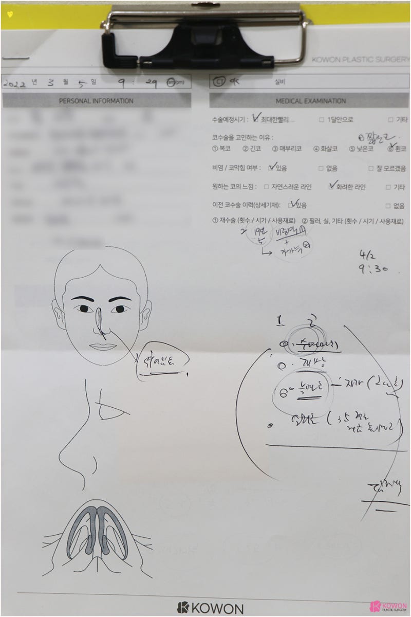 들창코재수술 자가늑연골 사용한 구축코성형