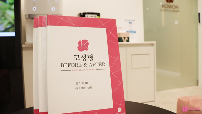 강남성형외과 화살코 개선한 코비순각 수술