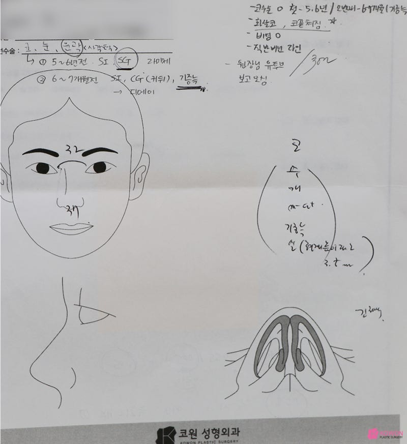 강남성형외과 화살코 개선한 코비순각 수술 사진 2