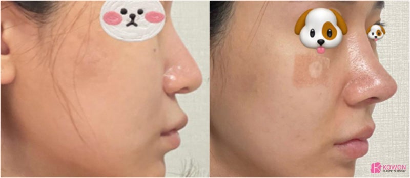 강남성형외과 화살코 개선한 코비순각 수술 사진 10