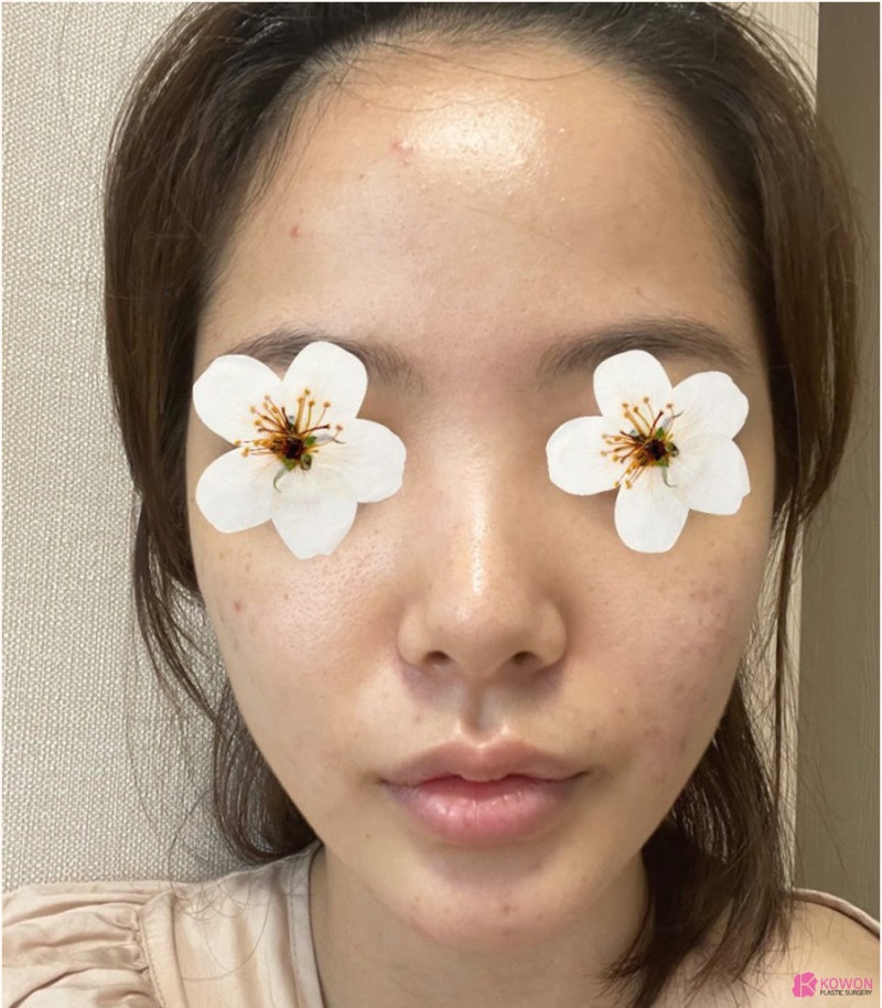 낮은코수술 직반버선라인 예쁜코 만든 사례 사진 3