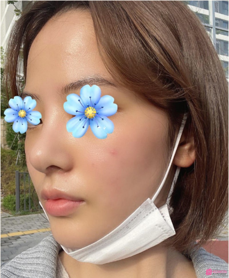 낮은코수술 직반버선라인 예쁜코 만든 사례 사진 9