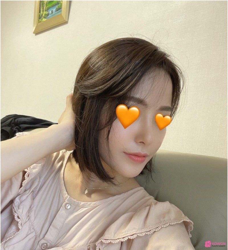 낮은코수술 직반버선라인 예쁜코 만든 사례 사진 11