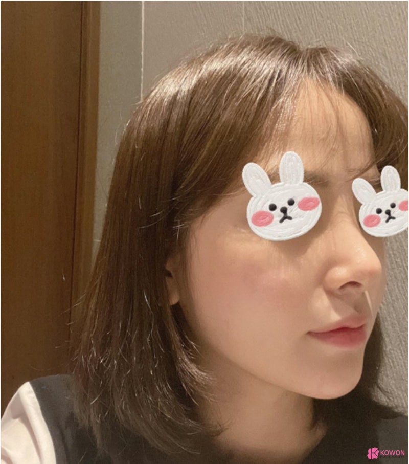 낮은코수술 직반버선라인 예쁜코 만든 사례 사진 5