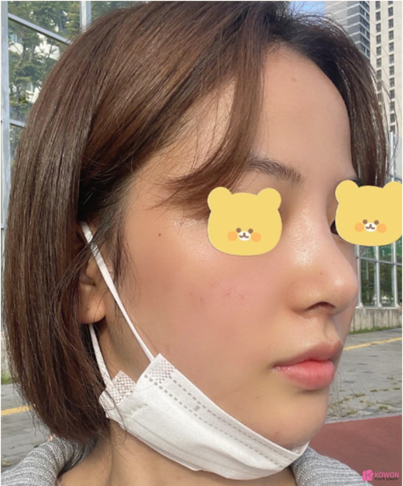 낮은코수술 직반버선라인 예쁜코 만든 사례 사진 8