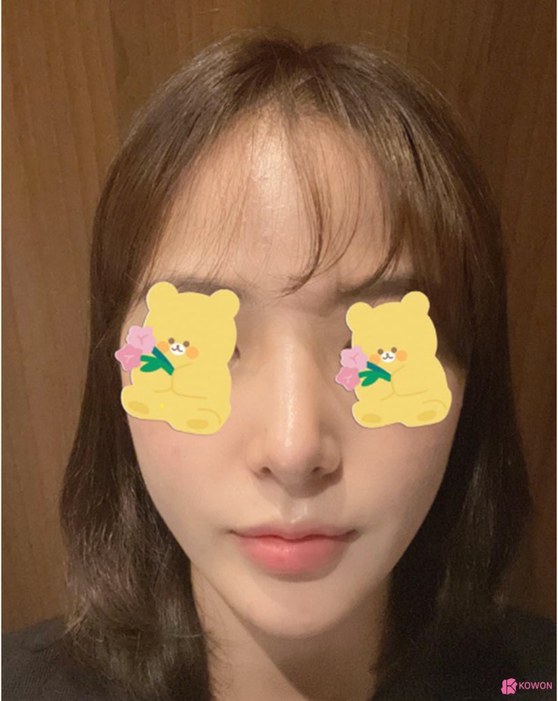 낮은코수술 직반버선라인 예쁜코 만든 사례 사진 7