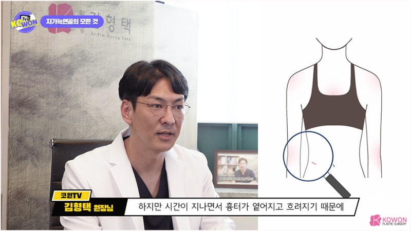 자가연골코성형 화려한코 만드는 방법 사진 9