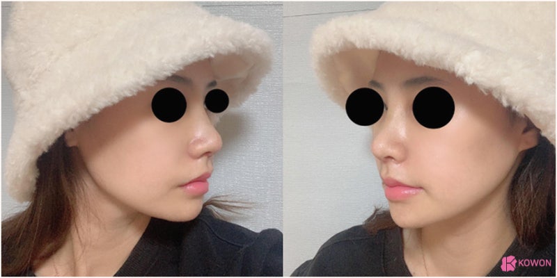 비중격만곡증성형외과 직반버선코 수술 경과 사진 9