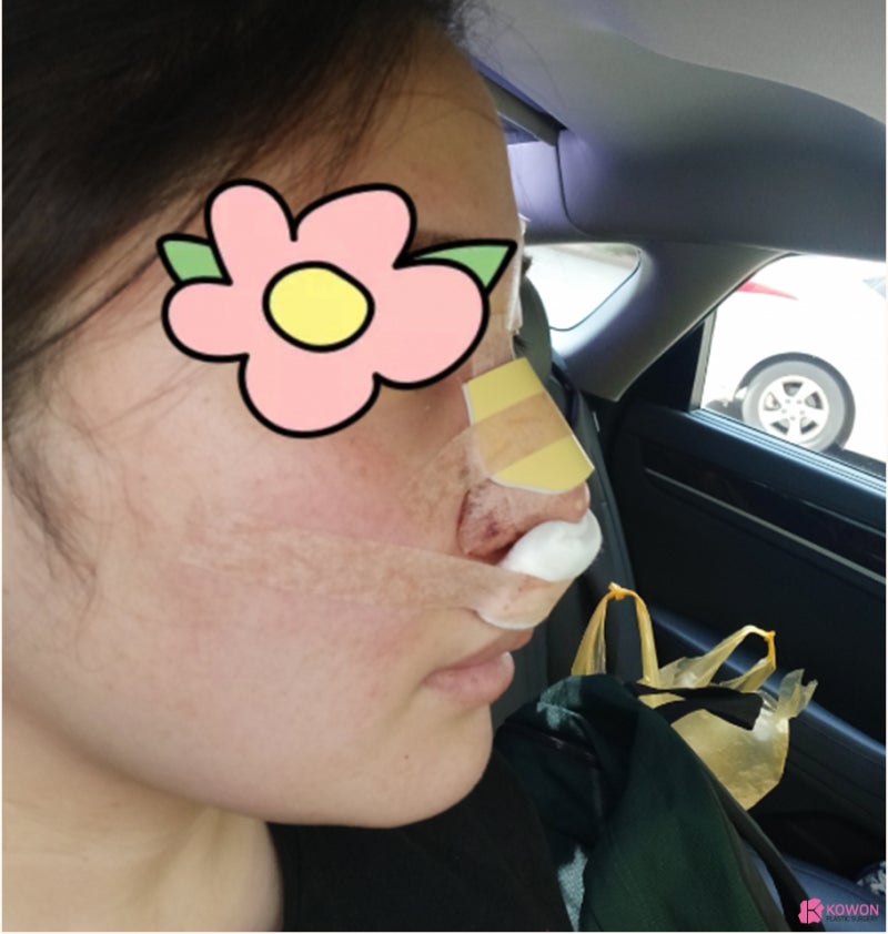 코수술병원 뭉툭한 복코코끝성형 사례 사진 5