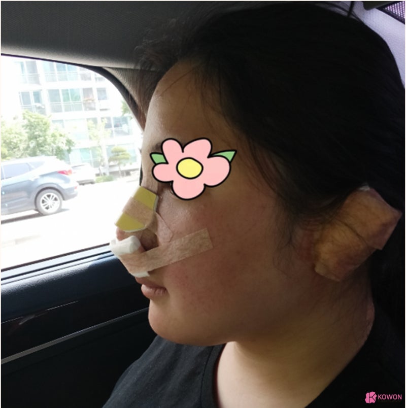 코수술병원 뭉툭한 복코코끝성형 사례 사진 7