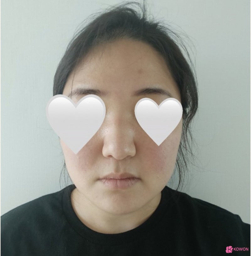 코수술병원 뭉툭한 복코코끝성형 사례 사진 4