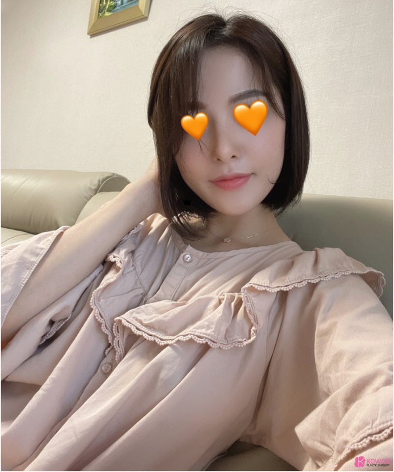 신논현역성형외과 낮고 짧은코 콤플렉스 해결 사진 12