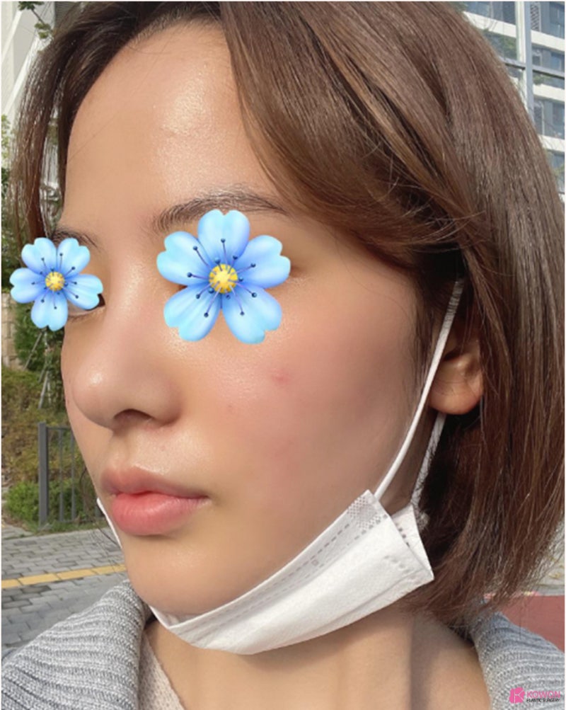 신논현역성형외과 낮고 짧은코 콤플렉스 해결 사진 8