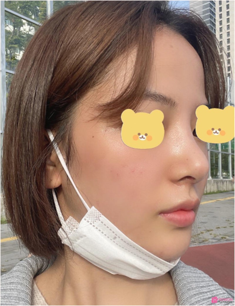 신논현역성형외과 낮고 짧은코 콤플렉스 해결 사진 10
